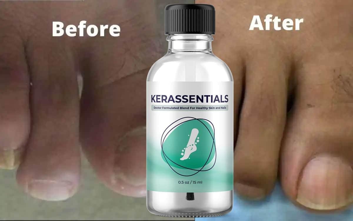 Kerassentials Before and after